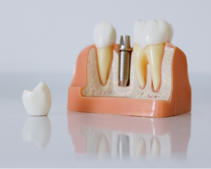 the science of osseointegration and its impact on dental implant success