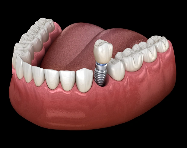 dental-implants