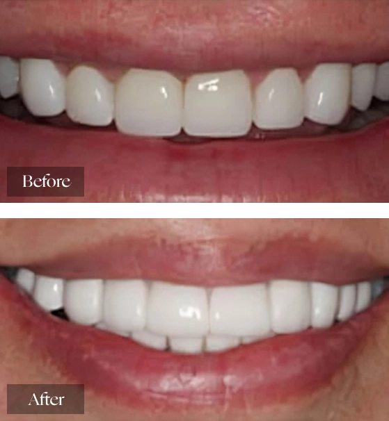 Smile Transformations